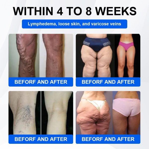 🔥Official Store🔥 | LBMLBM® SMGT-GLP-1 Nano Microneedle Patch with Collagen & Motrixyl 3000 | Targeting Obesity, Cardiovascular Disease, Diabetes, Sleep Apnea, Joint Issues & More