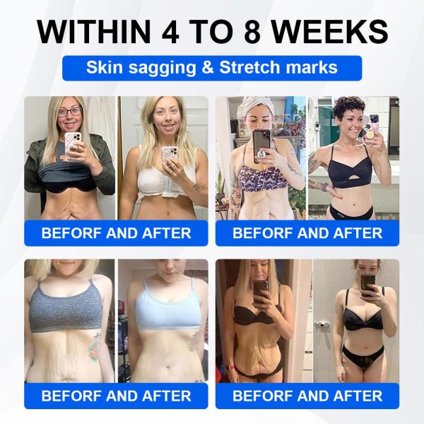 🔥Official Store🔥 | LBMLBM® SMGT-GLP-1 Nano Microneedle Patch with Collagen & Motrixyl 3000 | Targeting Obesity, Cardiovascular Disease, Diabetes, Sleep Apnea, Joint Issues & More